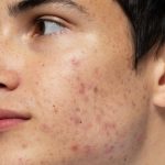 Hormonal Acne Homeopathy: Natural Remedies for Hormonal Imbalance