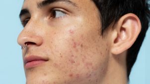 acne skin