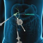 Best Gallbladder Surgeon in Bangalore | Dr. Bhushan Chittawadagi