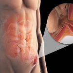The Complex Hernia: What Does It Mean? How is it treated?