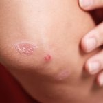 Psoriasis & Vitiligo Treatment in Pune