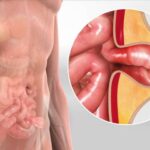 Umbilical Hernia Treatment in Pune