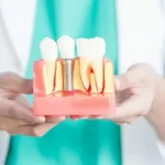 Benefits of Dental Implants Beyond Replacing Missing Teeth