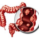 What Is Partial Colectomy? Complete Guide by Dr MSS Keerthi