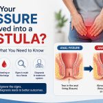 Has Your Fissure Evolved into a Fistula? Here’s What You Need to Know